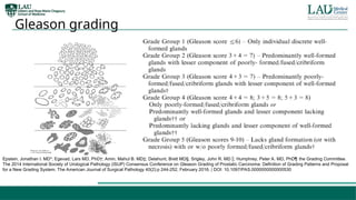 Prostate adenocarcinoma pathology presentation .ppt