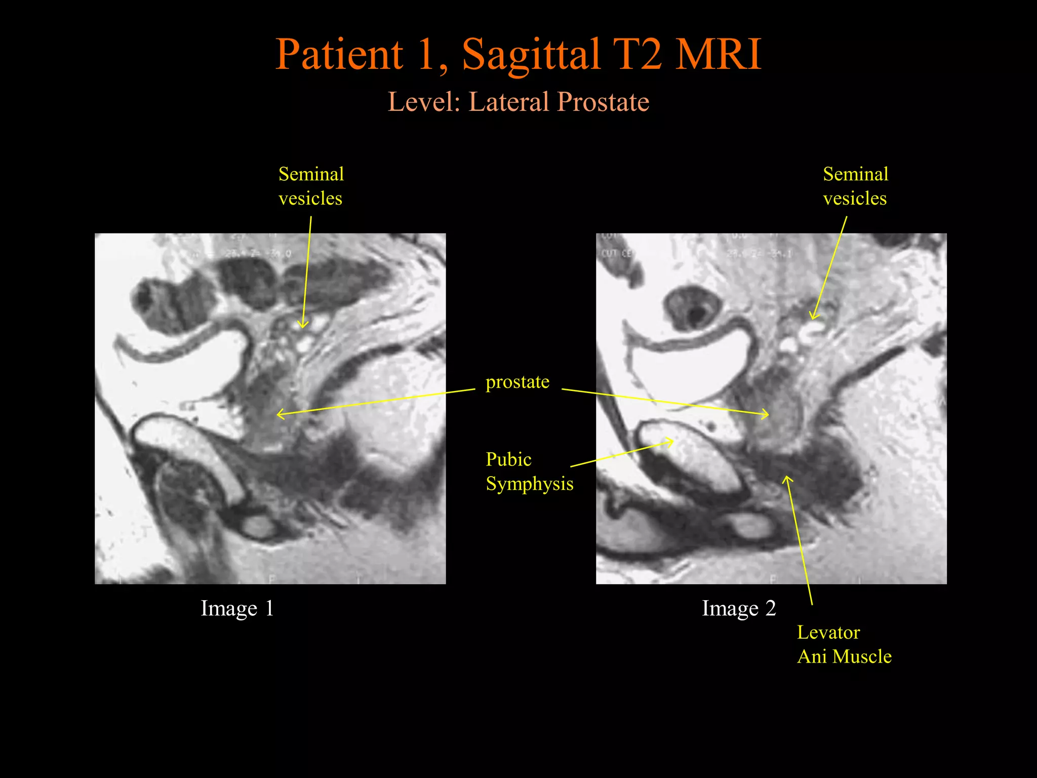 The Caffeine Mistake That Could Impact Your Prostate Mri - 58bjm9o