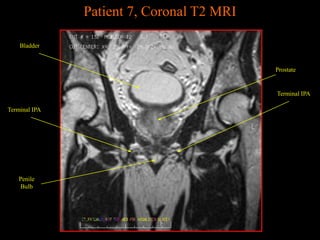 Prostate Coronal View Prostate MRI anatomy from UNIVERSITY OF MICHIGAN | PPTX