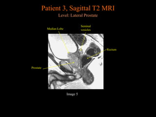 Prostate Coronal View Prostate MRI anatomy from UNIVERSITY OF MICHIGAN | PPTX
