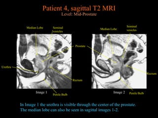 Prostate MRI anatomy from UNIVERSITY OF MICHIGAN | PPTX