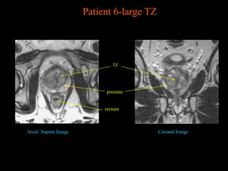 Prostate MRI anatomy from UNIVERSITY OF MICHIGAN | PPTX