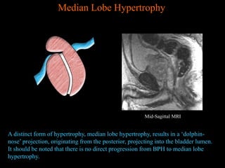 Prostate MRI anatomy from UNIVERSITY OF MICHIGAN | PPTX