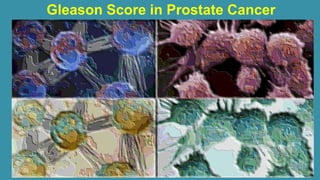 Gleason Score in Prostate Cancer
 