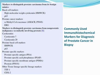 Commonly Used
Immunohistochemical
Markers for Diagnosis
of Prostate Cancer in
Biopsy
 