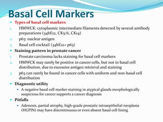 Basal Cell Markers
 Types of basal cell markers
1. HMWCK: cytoplasmic intermediate filaments detected by several antibody
preparations (34bE12, CK5/6, CK14)
2. p63: nuclear antigen
3. Basal cell cocktail (34bE12+ p63)
 Staining pattern in prostate cancer
1. Prostate carcinoma lacks staining for basal cell markers
2. HMWCK may rarely be positive in cancer cells, but not in basal cell
distribution, due to excessive antigen retrieval and staining
3. p63 can rarely be found in cancer cells with uniform and non-basal cell
distribution
 Diagnostic utility
 A negative basal cell marker staining in atypical glands morphologically
suspicious for cancer supports a cancer diagnosis
 Pitfalls
 Adenosis, partial atrophy, high-grade prostatic intraepithelial neoplasia
(HGPIN) may have discontinuous or even absent basal cell lining
 