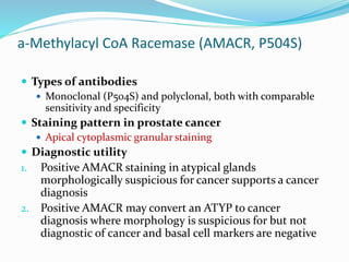 a-Methylacyl CoA Racemase (AMACR, P504S)
 Types of antibodies
 Monoclonal (P504S) and polyclonal, both with comparable
sensitivity and specificity
 Staining pattern in prostate cancer
 Apical cytoplasmic granular staining
 Diagnostic utility
1. Positive AMACR staining in atypical glands
morphologically suspicious for cancer supports a cancer
diagnosis
2. Positive AMACR may convert an ATYP to cancer
diagnosis where morphology is suspicious for but not
diagnostic of cancer and basal cell markers are negative
 