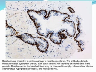 Basal cells are present in a continuous layer in most benign glands. The antibodies to high
molecular weight cytokeratin 34bE12 stain basal cells but not secretory or stromal cells in the
prostate. Besides cancer, the basal cell layer may be disrupted in atrophy, inflammation, atypical
adenomatous hyperplasia (adenosis), and high-grade PIN.
 