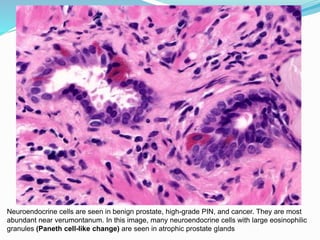 Neuroendocrine cells are seen in benign prostate, high-grade PIN, and cancer. They are most
abundant near verumontanum. In this image, many neuroendocrine cells with large eosinophilic
granules (Paneth cell-like change) are seen in atrophic prostate glands
 