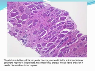 Skeletal muscle fibers of the urogenital diaphragm extend into the apical and anterior
peripheral regions of the prostate. Not infrequently, skeletal muscle fibers are seen in
needle biopsies from those regions
 