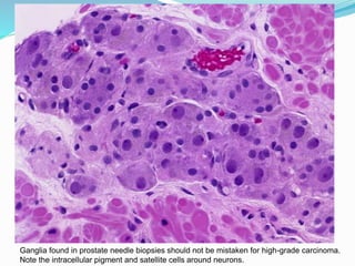 Ganglia found in prostate needle biopsies should not be mistaken for high-grade carcinoma.
Note the intracellular pigment and satellite cells around neurons.
 