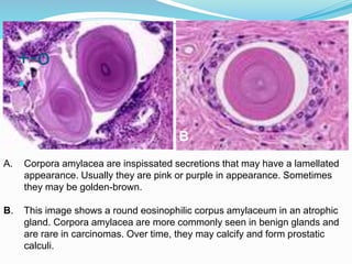 A. Corpora amylacea are inspissated secretions that may have a lamellated
appearance. Usually they are pink or purple in appearance. Sometimes
they may be golden-brown.
B. This image shows a round eosinophilic corpus amylaceum in an atrophic
gland. Corpora amylacea are more commonly seen in benign glands and
are rare in carcinomas. Over time, they may calcify and form prostatic
calculi.
A B
+-o

 