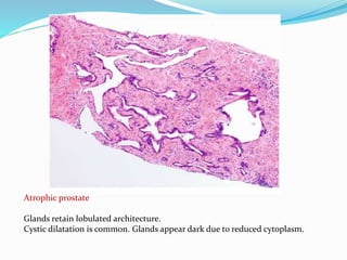 Atrophic prostate
Glands retain lobulated architecture.
Cystic dilatation is common. Glands appear dark due to reduced cytoplasm.
 