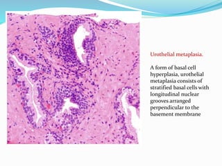Urothelial metaplasia.
A form of basal cell
hyperplasia, urothelial
metaplasia consists of
stratified basal cells with
longitudinal nuclear
grooves arranged
perpendicular to the
basement membrane
 