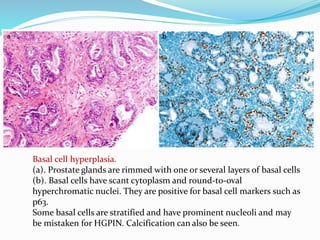 Basal cell hyperplasia.
(a). Prostate glands are rimmed with one or several layers of basal cells
(b). Basal cells have scant cytoplasm and round-to-oval
hyperchromatic nuclei. They are positive for basal cell markers such as
p63.
Some basal cells are stratified and have prominent nucleoli and may
be mistaken for HGPIN. Calcification can also be seen.
 
