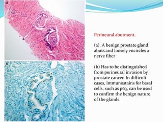 Perineural abutment.
(a). A benign prostate gland
abuts and loosely encircles a
nerve fiber
(b) Has to be distinguished
from perineural invasion by
prostate cancer. In difficult
cases, immunostains for basal
cells, such as p63, can be used
to confirm the benign nature
of the glands
 