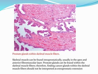 Prostate glands within skeletal muscle fibers.
Skeletal muscle can be found intraprostatically, usually in the apex and
anterior fibromuscular layer. Prostate glands can be found within the
skeletal muscle fibers; therefore, finding cancer glands within the skeletal
muscle fibers should not be interpreted as extraprostatic extension
 