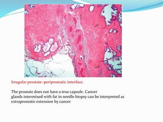 Irregular prostate–periprostatic interface.
The prostate does not have a true capsule. Cancer
glands intermixed with fat in needle biopsy can be interpreted as
extraprostatic extension by cancer
 