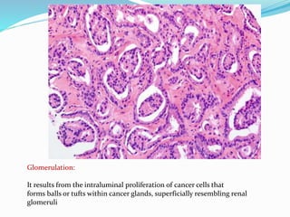 Glomerulation:
It results from the intraluminal proliferation of cancer cells that
forms balls or tufts within cancer glands, superficially resembling renal
glomeruli
 