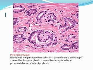 l
Perineural invasion:
It is defined as tight circumferential or near circumferential encircling of
a nerve fiber by cancer glands. It should be distinguished from
perineural abutment by benign glands.
 