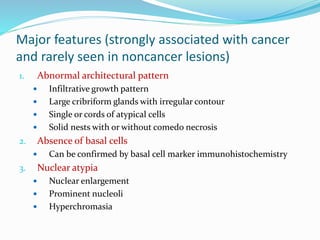 Major features (strongly associated with cancer
and rarely seen in noncancer lesions)
1. Abnormal architectural pattern
 Infiltrative growth pattern
 Large cribriform glands with irregular contour
 Single or cords of atypical cells
 Solid nests with or without comedo necrosis
2. Absence of basal cells
 Can be confirmed by basal cell marker immunohistochemistry
3. Nuclear atypia
 Nuclear enlargement
 Prominent nucleoli
 Hyperchromasia
 