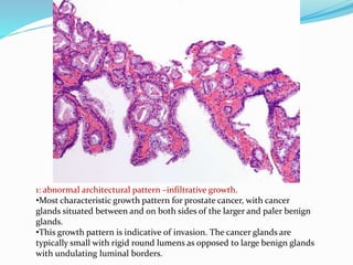 1: abnormal architectural pattern –infiltrative growth.
•Most characteristic growth pattern for prostate cancer, with cancer
glands situated between and on both sides of the larger and paler benign
glands.
•This growth pattern is indicative of invasion. The cancer glands are
typically small with rigid round lumens as opposed to large benign glands
with undulating luminal borders.
 