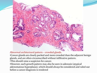 Abnormal architectural pattern – crowded glands.
•Cancer glands are closely packed and more crowded than the adjacent benign
glands, and are often circumscribed without infiltrative pattern.
•This should raise a suspicion for cancer.
•However, such growth pattern may also be seen in adenosis (atypical
adenomatous hyperplasia), which should always be considered and ruled out
before a cancer diagnosis is rendered
 