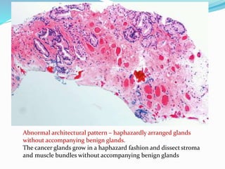 Abnormal architectural pattern – haphazardly arranged glands
without accompanying benign glands.
The cancer glands grow in a haphazard fashion and dissect stroma
and muscle bundles without accompanying benign glands
 
