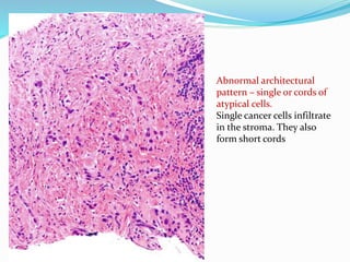 Abnormal architectural
pattern – single or cords of
atypical cells.
Single cancer cells infiltrate
in the stroma. They also
form short cords
 