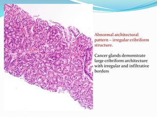 Abnormal architectural
pattern – irregular cribriform
structure.
Cancer glands demonstrate
large cribriform architecture
with irregular and infiltrative
borders
 