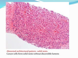 Abnormal architectural pattern –solid nests.
Cancer cells form solid nests without discernible lumens
 