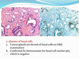 2: absence of basal cells.
a. Cancer glands are devoid of basal cells on H&E
examination
b. Confirmed by immunostain for basal cell marker p63
which is negative
 