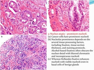 3: Nuclear atypia – prominent nucleoli.
(a) Cancer cells have prominent nucleoli
(b) Nucleolar prominence depends on the
several tissue processing factors,
including fixation, tissue section
thickness, and staining protocols.
Alcohol-based fixatives often obscure the
nuclear detail with blurred chromatin
and inconspicuous nucleoli
(c) Whereas Hollandes fixative enhances
nucleoli with visible nucleoli even in
basal cells of benign glands
 