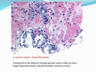 3: nuclear atypia – hyperchromasia.
Compared to the adjacent benign glands, cancer cells can have
larger hyperchromatic and pleomorphic nuclei (arrows)
 
