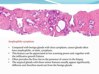 Amphophilic cytoplasm.
• Compared with benign glands with clear cytoplasm, cancer glands often
have amphophilic, or dark, cytoplasm.
• This feature can be appreciated at low scanning power and, together with
the infiltrative growth Pattern
• Often provides the first clue to the presence of cancer in the biopsy.
• The atypical glands with these minor features usually appear significantly
different and therefore stand out from the benign glands
 