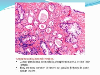 Amorphous intraluminal secretion.
• Cancer glands have eosinophilic amorphous material within their
lumens.
• They are more common in cancer, but can also be found in some
benign lesions
 