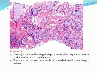 Blue mucin.
• Cancer glands have blue-tinged wisps of mucin, often together with dense
pink secretion, within their lumens.
• They are more common in cancer, but can also be found in some benign
lesions.
 