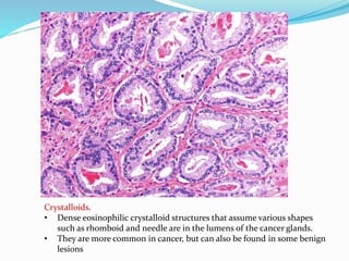 Crystalloids.
• Dense eosinophilic crystalloid structures that assume various shapes
such as rhomboid and needle are in the lumens of the cancer glands.
• They are more common in cancer, but can also be found in some benign
lesions
 