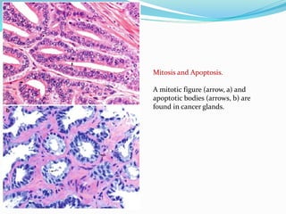 Mitosis and Apoptosis.
A mitotic figure (arrow, a) and
apoptotic bodies (arrows, b) are
found in cancer glands.
 