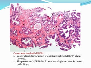 Cancer associated with HGPIN.
1. Cancer glands (arrowheads) often intermingle with HGPIN glands
(arrows).
2. The presence of HGPIN should alert pathologists to look for cancer
in the biopsy
 