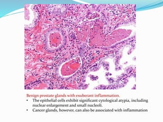 Benign prostate glands with exuberant inflammation.
• The epithelial cells exhibit significant cytological atypia, including
nuclear enlargement and small nucleoli.
• Cancer glands, however, can also be associated with inflammation
 