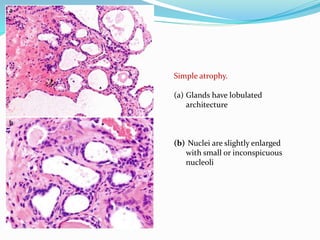 Simple atrophy.
(a) Glands have lobulated
architecture
(b) Nuclei are slightly enlarged
with small or inconspicuous
nucleoli
 
