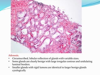Adenosis.
• Circumscribed, lobular collection of glands with variable sizes.
• Some glands are clearly benign with large irregular contour and undulating
luminal borders.
• Smaller glands with rigid lumens are identical to larger benign glands
cytologically
 