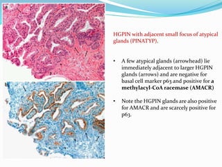 HGPIN with adjacent small focus of atypical
glands (PINATYP).
• A few atypical glands (arrowhead) lie
immediately adjacent to larger HGPIN
glands (arrows) and are negative for
basal cell marker p63 and positive for a
methylacyl-CoA racemase (AMACR)
• Note the HGPIN glands are also positive
for AMACR and are scarcely positive for
p63.
 