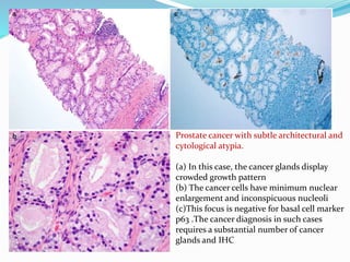 Prostate cancer with subtle architectural and
cytological atypia.
(a) In this case, the cancer glands display
crowded growth pattern
(b) The cancer cells have minimum nuclear
enlargement and inconspicuous nucleoli
(c)This focus is negative for basal cell marker
p63 .The cancer diagnosis in such cases
requires a substantial number of cancer
glands and IHC
 