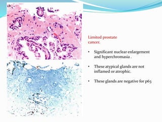Limited prostate
cancer.
• Significant nuclear enlargement
and hyperchromasia .
• These atypical glands are not
inflamed or atrophic.
• These glands are negative for p63
 