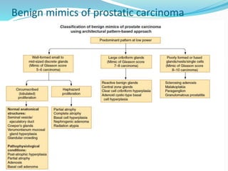 Benign mimics of prostatic carcinoma
 