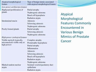 Atypical
Morphological
Features Commonly
Encountered in
Various Benign
Mimics of Prostate
Cancer
 