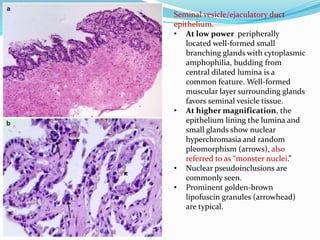 Seminal vesicle/ejaculatory duct
epithelium.
• At low power peripherally
located well-formed small
branching glands with cytoplasmic
amphophilia, budding from
central dilated lumina is a
common feature. Well-formed
muscular layer surrounding glands
favors seminal vesicle tissue.
• At higher magnification, the
epithelium lining the lumina and
small glands show nuclear
hyperchromasia and random
pleomorphism (arrows), also
referred to as “monster nuclei.”
• Nuclear pseudoinclusions are
commonly seen.
• Prominent golden-brown
lipofuscin granules (arrowhead)
are typical.
 