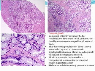 • Cowper’s glands.
• Composed of tightly circumscribed or
lobulated proliferation of small, uniform acini
lined by mucus-containing cells with a central
duct.
• This dimorphic population of ducts (arrow)
surrounded by acini is characteristic .
Cytological features are bland, including small
nuclei and inconspicuous nucleoli.
• Mucin is present in the intracellular
compartment in contrast to intraluminal
mucin in prostate cancer
• Skeletal muscle is frequently present in stroma
 